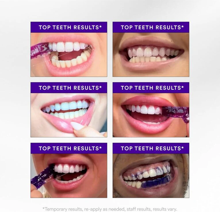 Whitening Strips: ‘’The Fast Track to a Stunning Smile!‘’ - Image 3