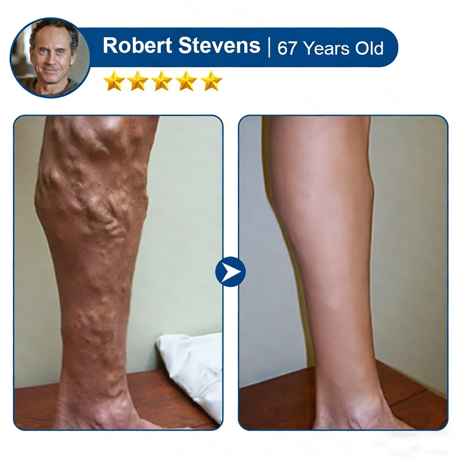 Vein ContourMicroneedle Patch with AdvancedDiosmin & Hesperidin Delivery 🌿 7-Day Visible Results for VaricoseVeins - Image 11